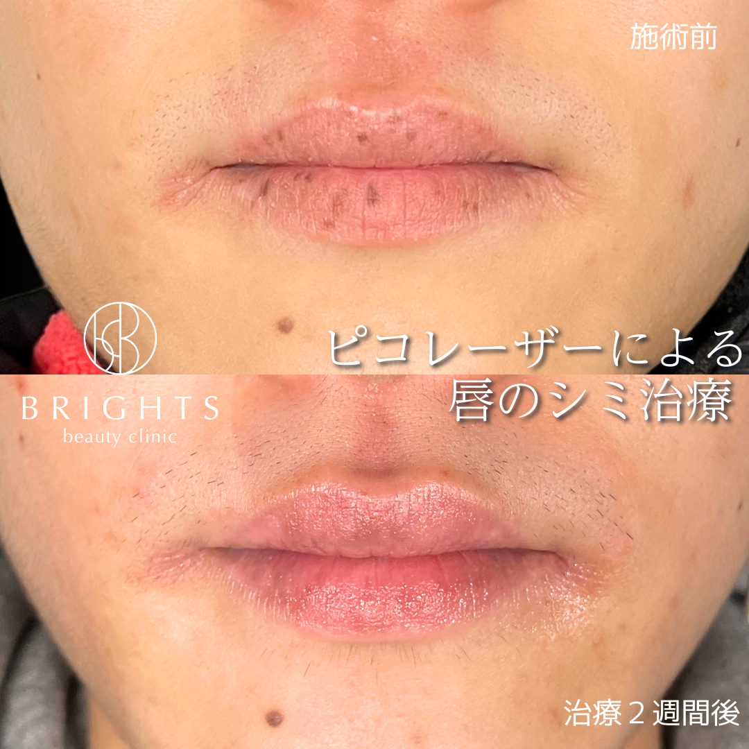 男性の唇のシミ取り ピコレーザー 施術前と治療2週間後の症例写真 さいたま市浦和 BRIGHTS beauty clinic