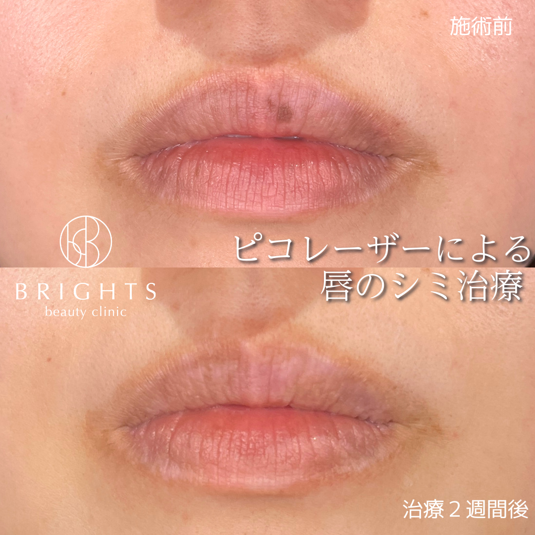 施術前・施術後