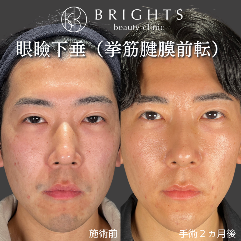切開眼瞼下垂 挙筋腱膜前転法 術前術後 男性の重たい目元の変化 浦和のBRIGHTS beauty clinic