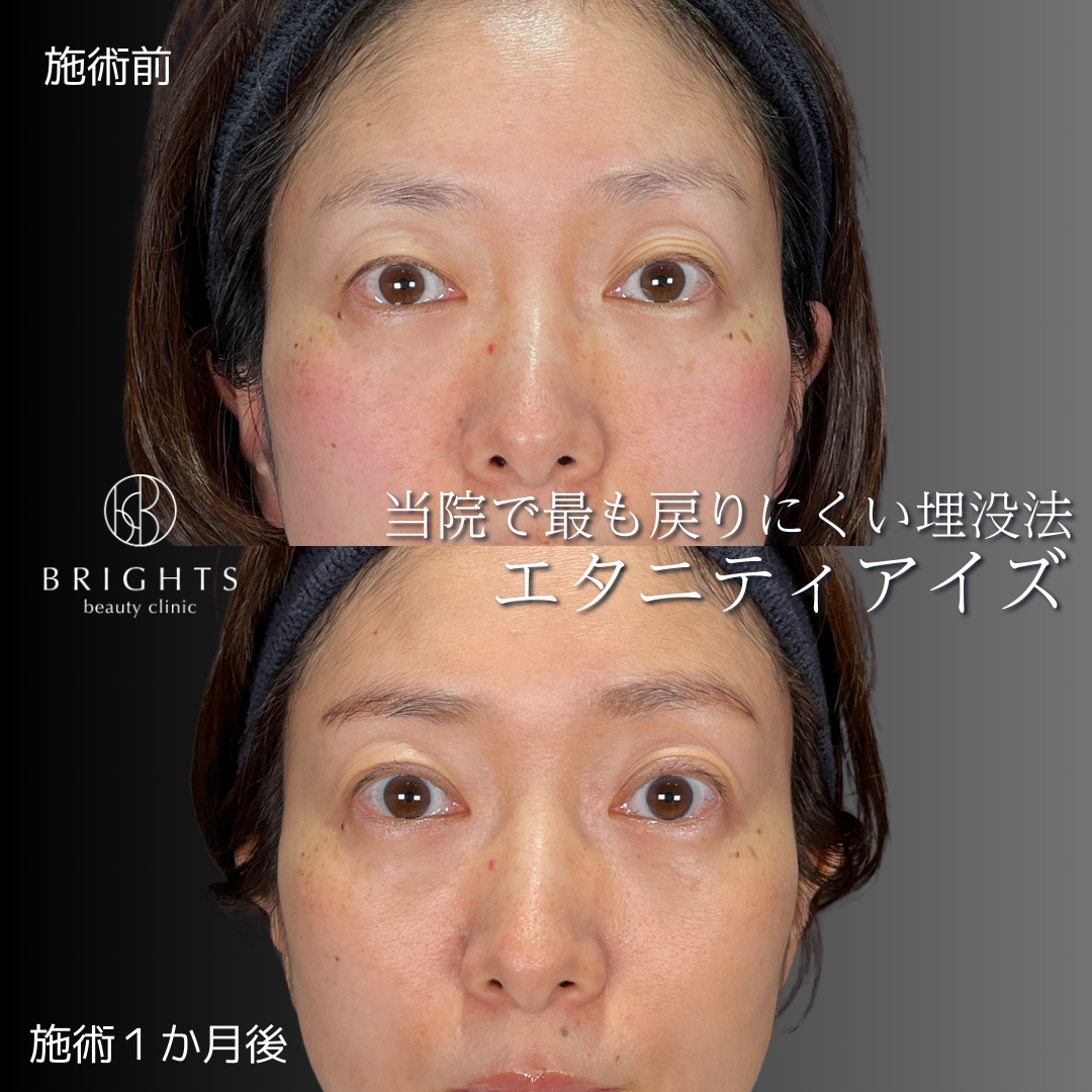 二重埋没法エタニティアイズの術前と術後1か月の目元写真（症例49）｜BRIGHTS beauty clinic
