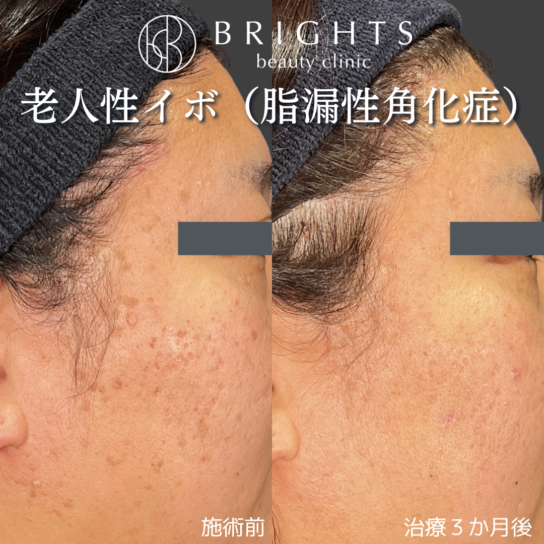 施術前・施術後