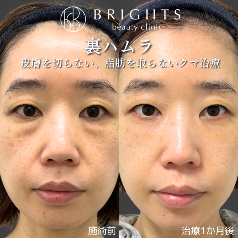 裏ハムラ法 皮膚を切らず脂肪を取らずに影クマが改善しフラットな目元になった症例