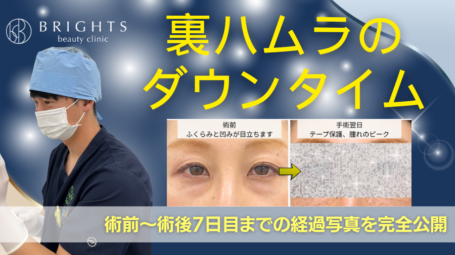 裏ハムラのダウンタイムは何日？術後の経過写真を美容外科医が完全公開