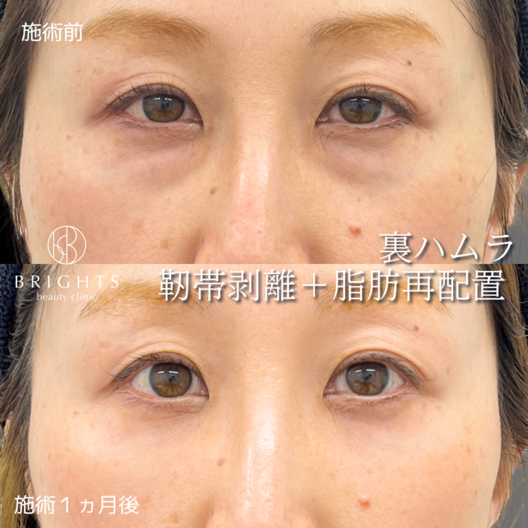裏ハムラ法 術後1ヶ月 目の下のふくらみと影クマが改善しティアトラフが目立たなくなった40代女性