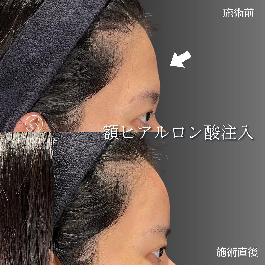 額ヒアルロン酸注入の施術前と施術直後 平らな額に丸みが出た20代女性の横顔