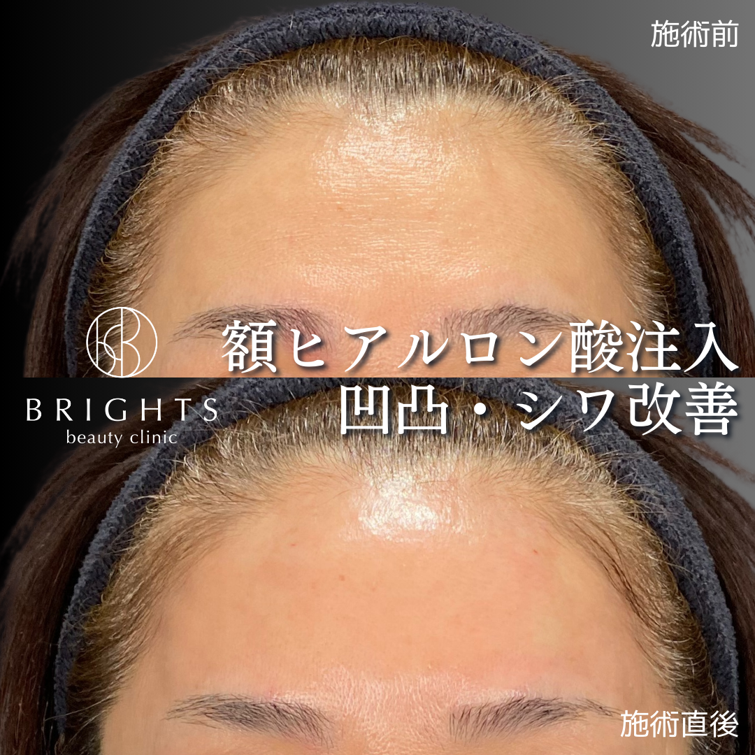 額ヒアルロン酸注入の施術前と施術直後 凹凸とシワが改善した40代女性の横顔