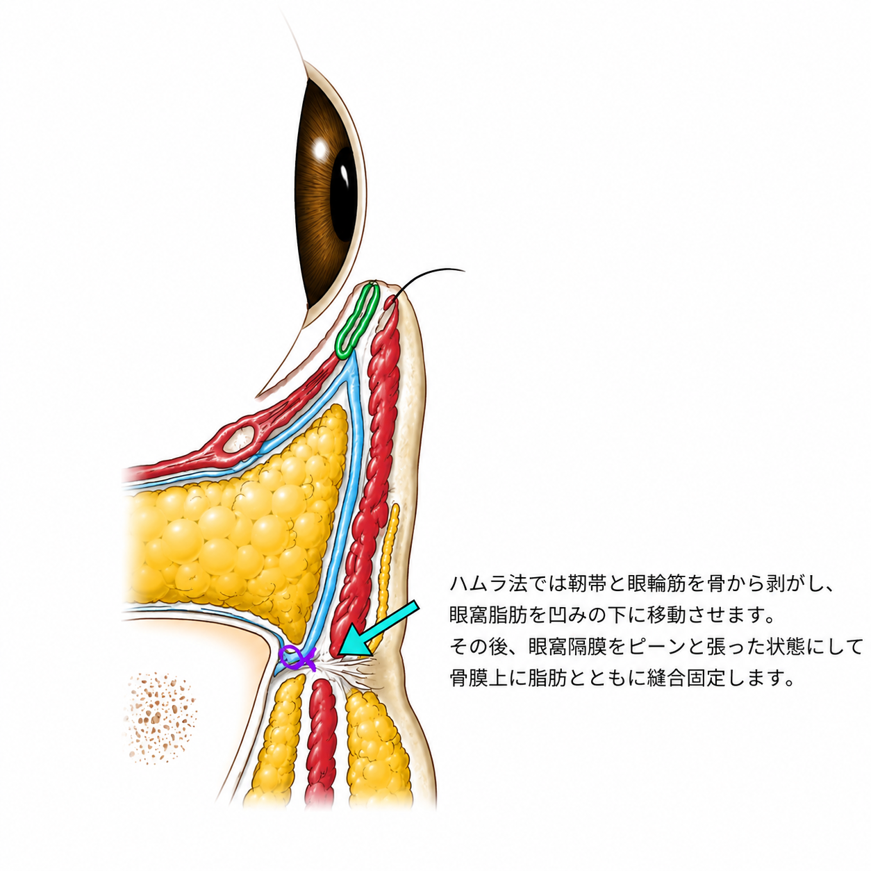 しくみ図・術後