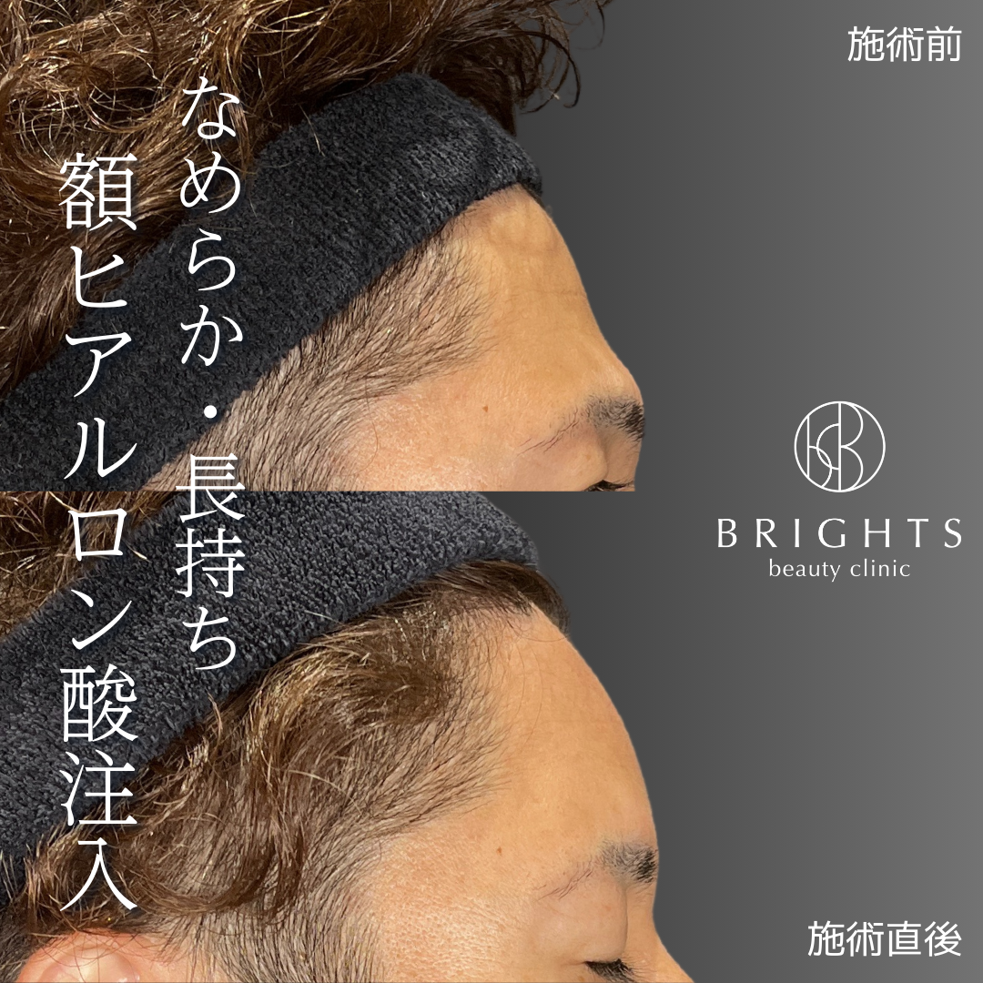 額ヒアルロン酸注入の施術前と施術直後 デコボコした額がなめらかになった30代男性の横顔
