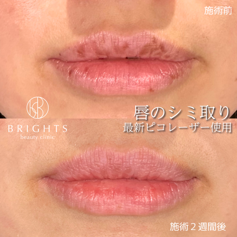 30代女性の唇のシミ取り ピコレーザー 施術前と施術2週間後 上口唇の点状色素斑が改善した症例写真 浦和