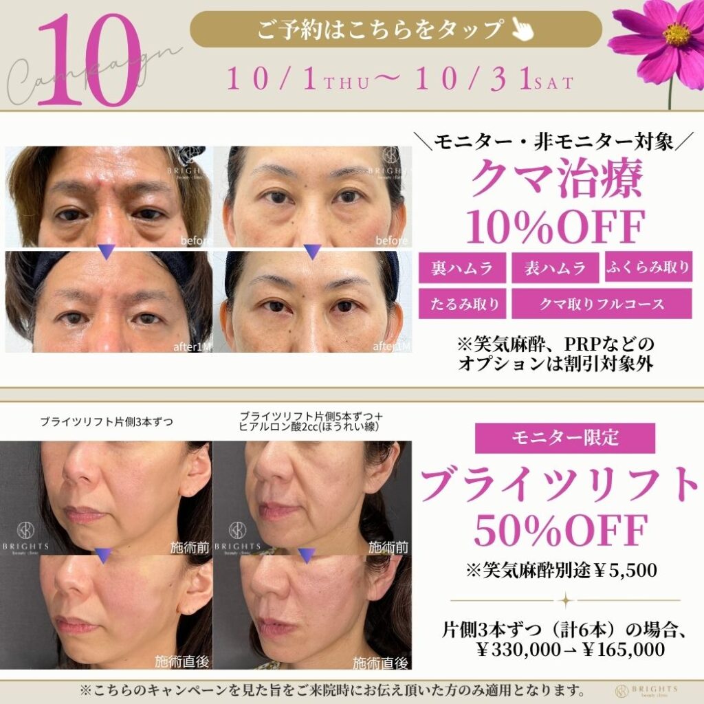2026年10月 クマ治療10％OFF・ブライツリフト50％OFFキャンペーン