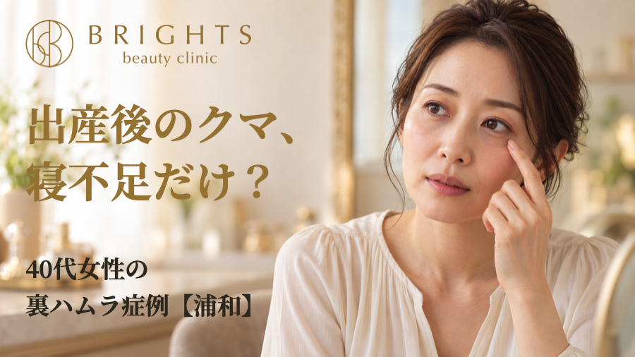 出産後のクマ、寝不足だけ？40代女性の裏ハムラ症例【浦和】